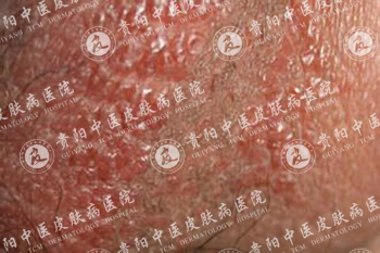 贵阳中医皮肤医院 湿疹 > 专家解析湿疹症状图    由于接触外界各种
